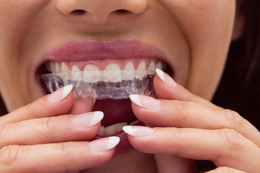 How Much Does Invisalign Cost, and Is It Worth It