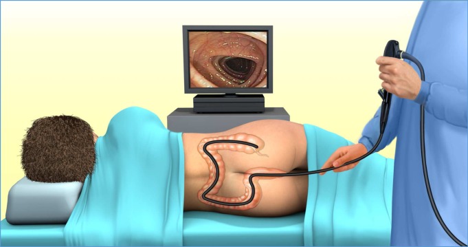 Colonoscopy is a new knowledge that