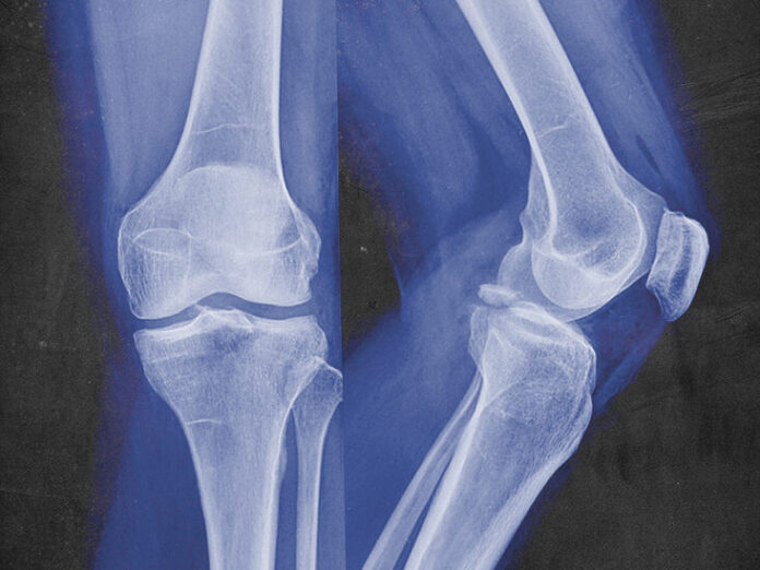 Fractures in Bones: Their Types, Causes, Symptoms, and Treatment Available