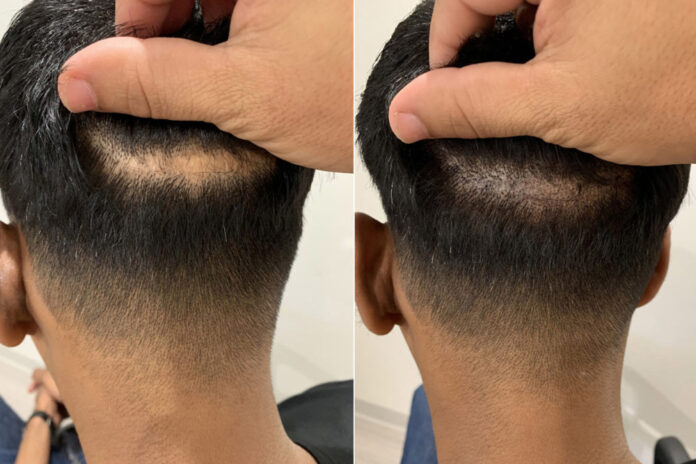 What is scalp micropigmentation?