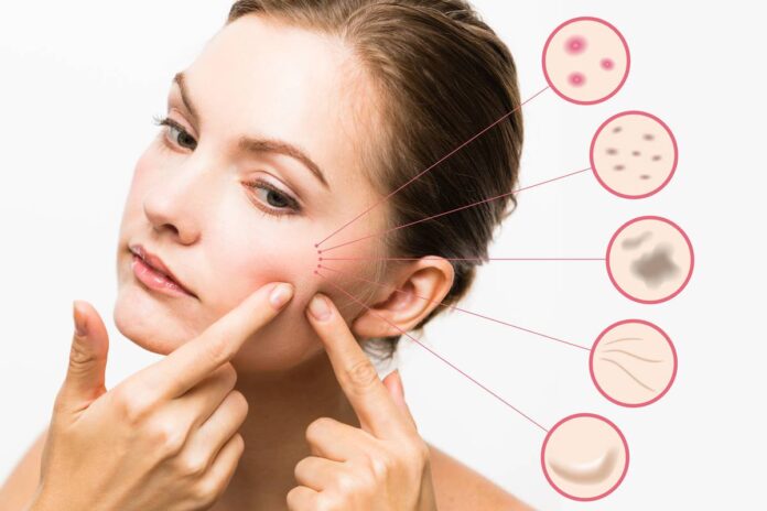 Everything you need to know about acne treatment