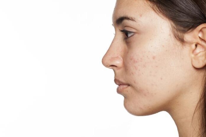How Hormonal Imbalance Acne Affects