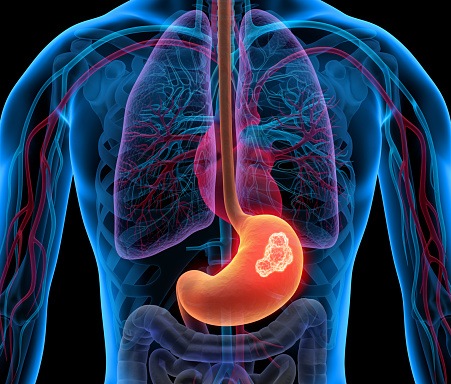 Stomach Cancer.