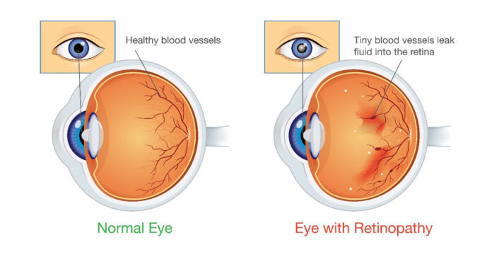 The Ultimate Guide About Know About Diabetic Retinopathy