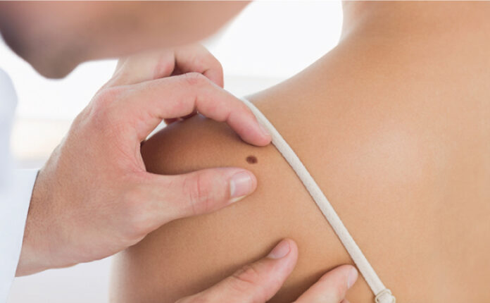 When and where to get moles checked?
