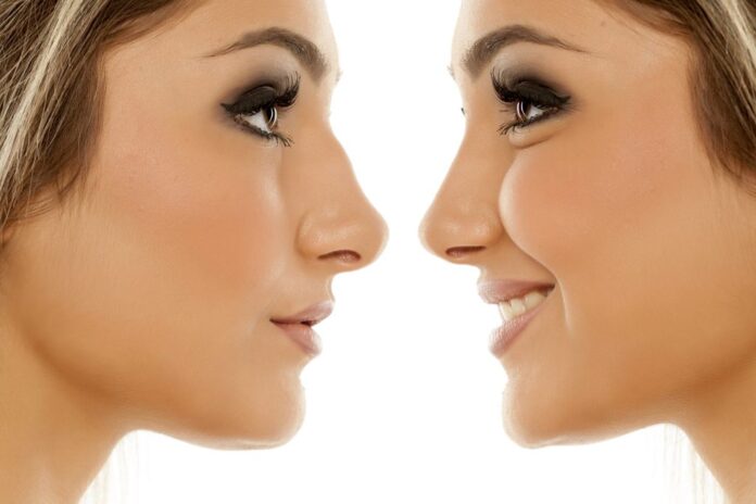 Open And Closed Rhinoplasty